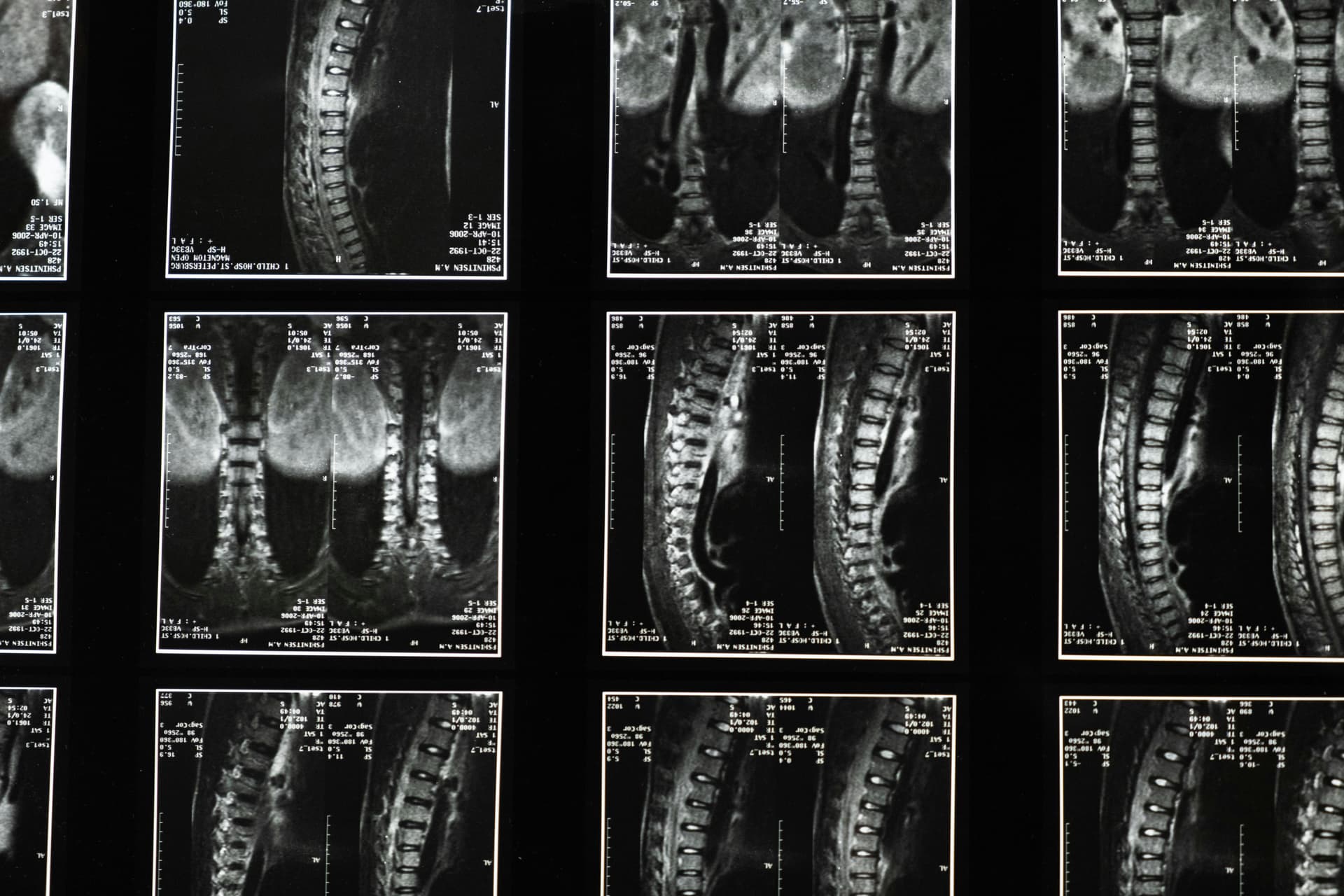 The Intracept® Procedure: Bringing Relief to Chronic Back Pain