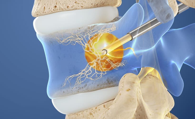 The Intracept® Procedure: Bringing Relief to Chronic Back Pain